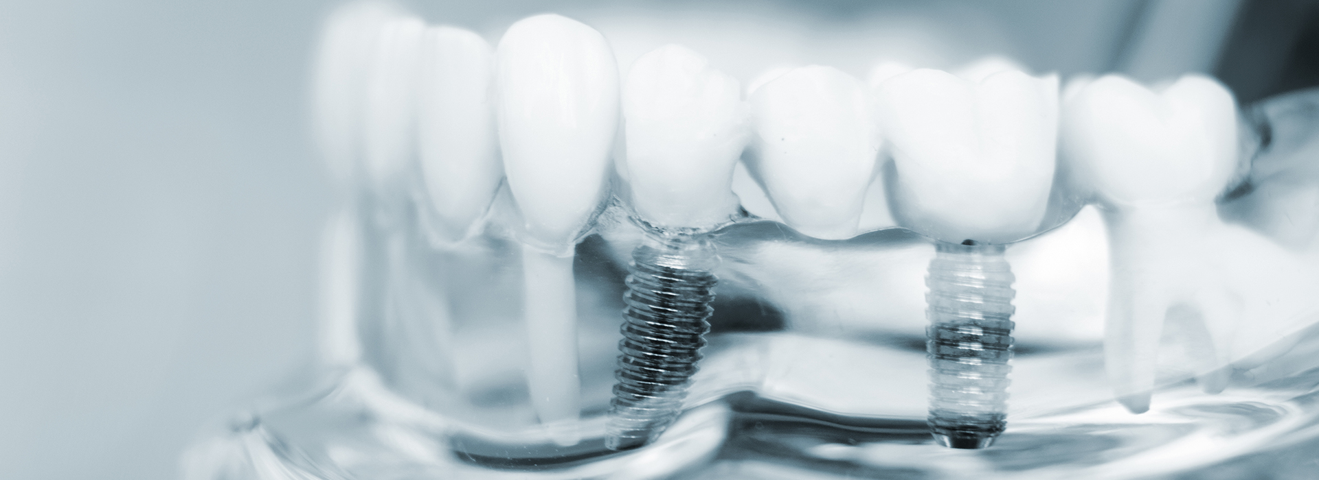 The image displays a close-up of multiple teeth with visible dental implants, set against a blurred background that suggests a clinical or medical setting.