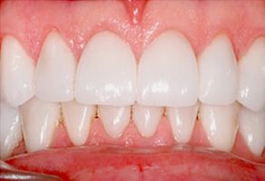 The image shows a close-up of a person s mouth with teeth and gums visible, highlighting dental health care.