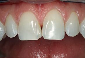The image shows a close-up view of a person s teeth, with visible signs of wear or damage, such as discoloration or chipping, set against a background that appears to be a dental setting due to the presence of dental equipment and materials.